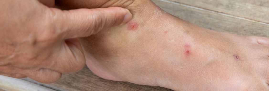 ухапвания от бълхи