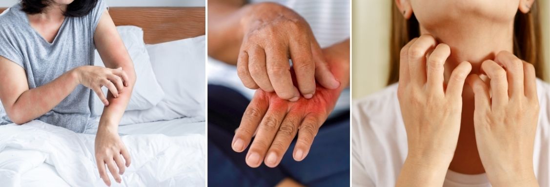 Алергични реакции причинени от акари