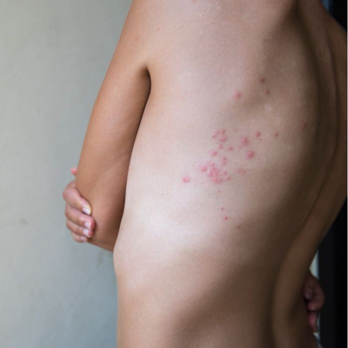 как изглежда ухапване от дървеници