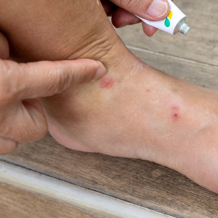 Ухапвания от бълха