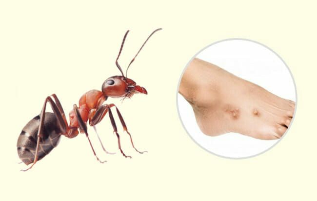 ухапване от мравки, как изглежда